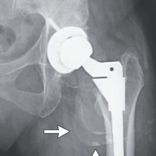 Woman’s puzzling decline turns out to be cobalt poisoning from hip replacement
