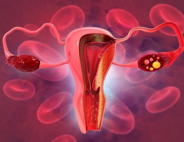 Overlooked parasitic disease linked to HIV and cervical cancer risk