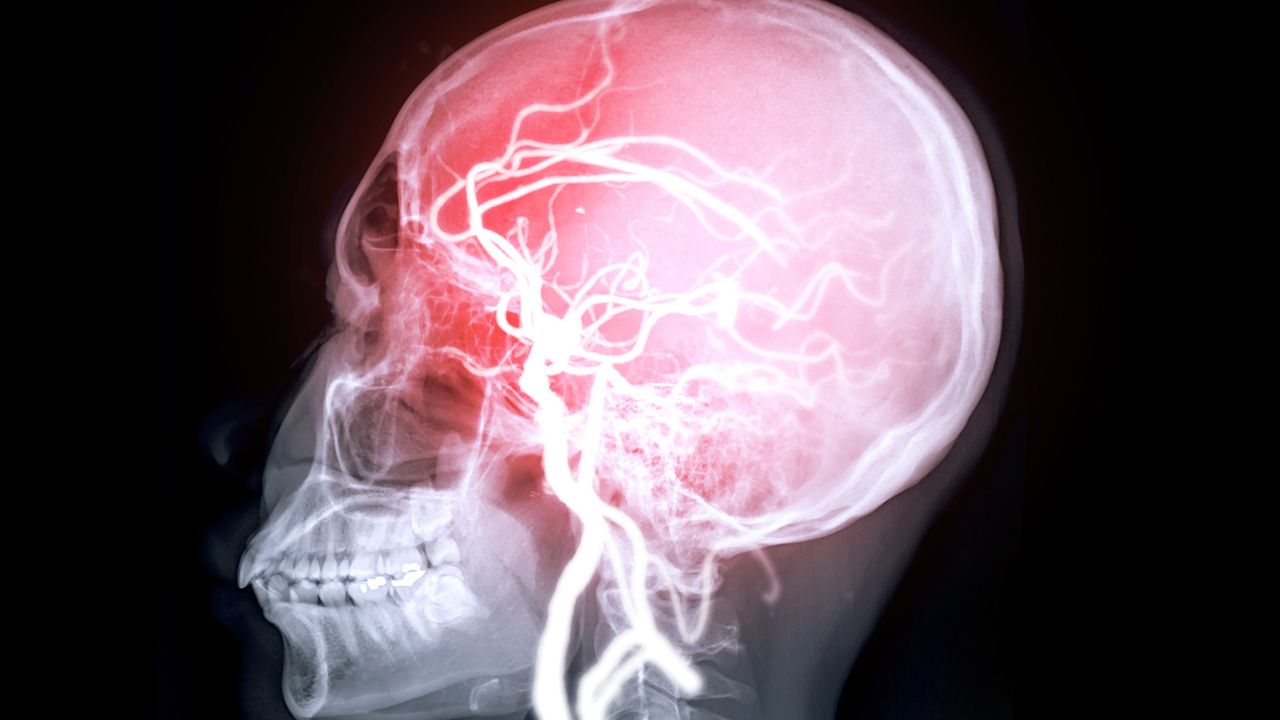 Heart issues tied to ‘microdamage’ in the brain might raise risk of memory loss, study hints