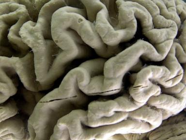 Study shows blood test can help identify people at high risk for Alzheimer’s disease