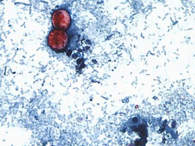15 states now linked to iceberg lettuce cyclospora outbreak, CDC says