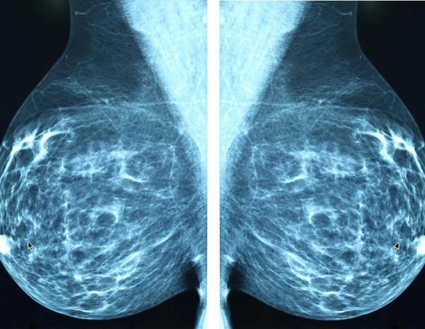 Two-gene interaction reveals metastatic risk in breast cancer