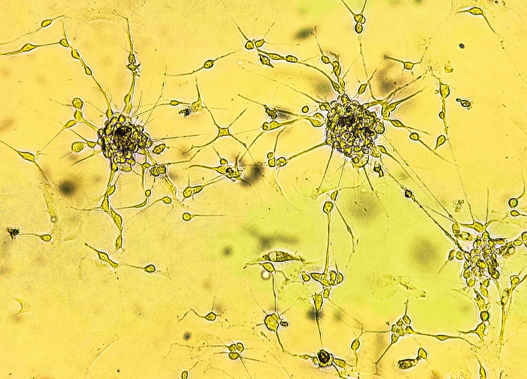 Cannabis compounds may weaken glioblastoma response to chemotherapy and radiation
