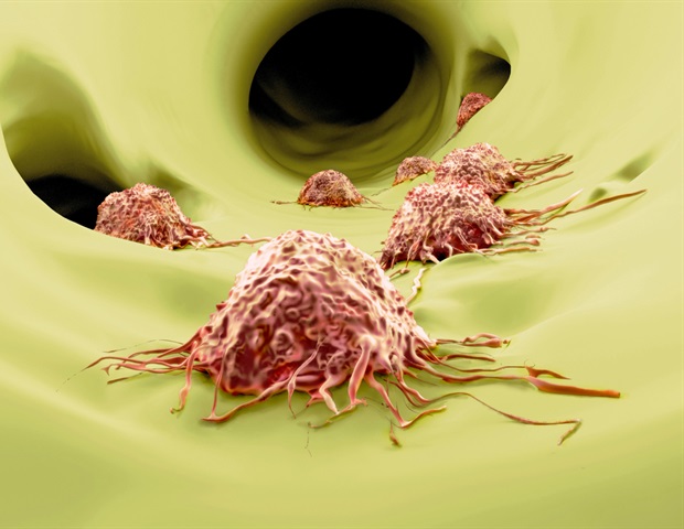 AI-based methods help uncover hidden roots of tumor metastasis