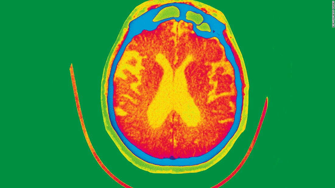 Experimental therapy gantenerumab fails to slow or improve Alzheimer’s memory loss in clinical trials