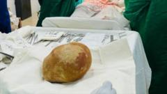 Doctors remove record-size bladder stone