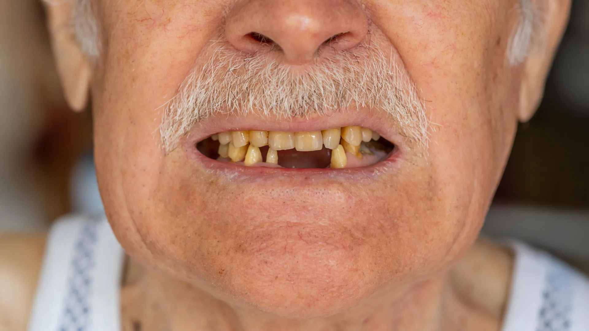 Tooth count may predict survival after pancreatic cancer surgery