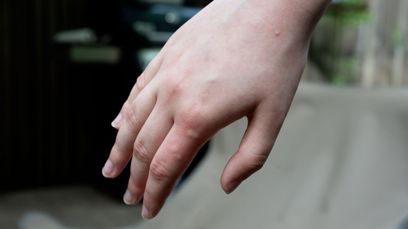 Your skin chemistry may affect which mosquitoes most want to bite you 