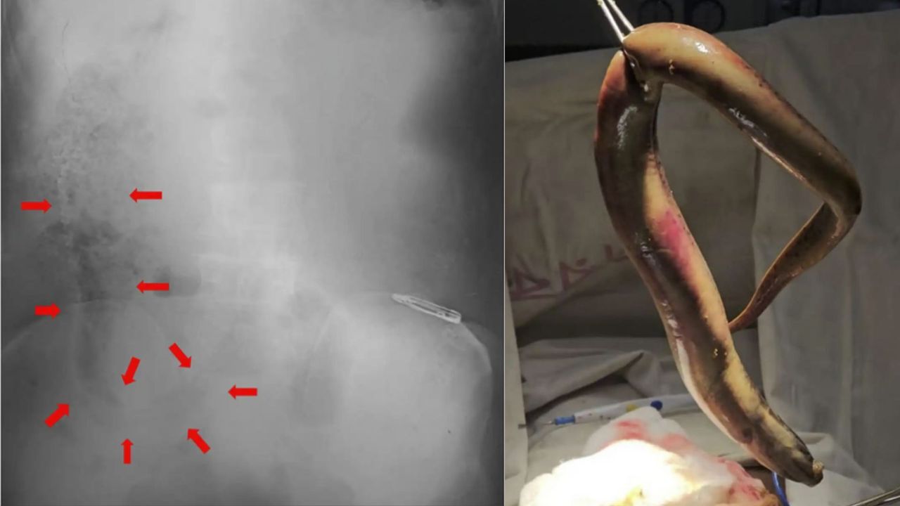 Diagnostic dilemma: Fisher’s colon punctured by eel that snuck in through his rectum