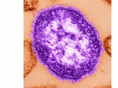 Coroner releases details of infants who died amid growing measles outbreak