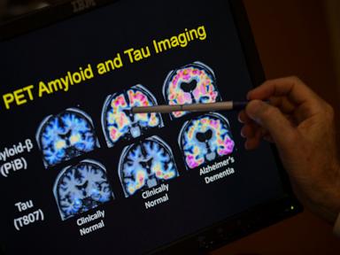Want to lower your risk of dementia? It doesn’t involve a blood test