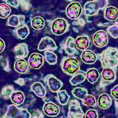 Unvaccinated Pennsylvania woman died of measles complications, coroner says