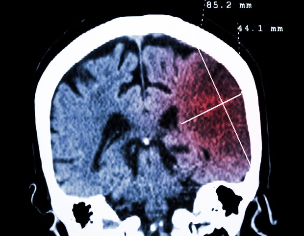 Genetic variant accelerates Huntington’s disease onset by over a decade