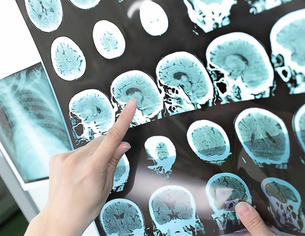 Genetic discovery offers clues for repairing damaged neural connections