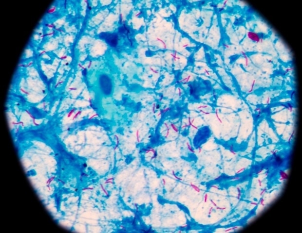 Immunotherapy combined with BCG vaccine drastically lowers tuberculosis relapse risk
