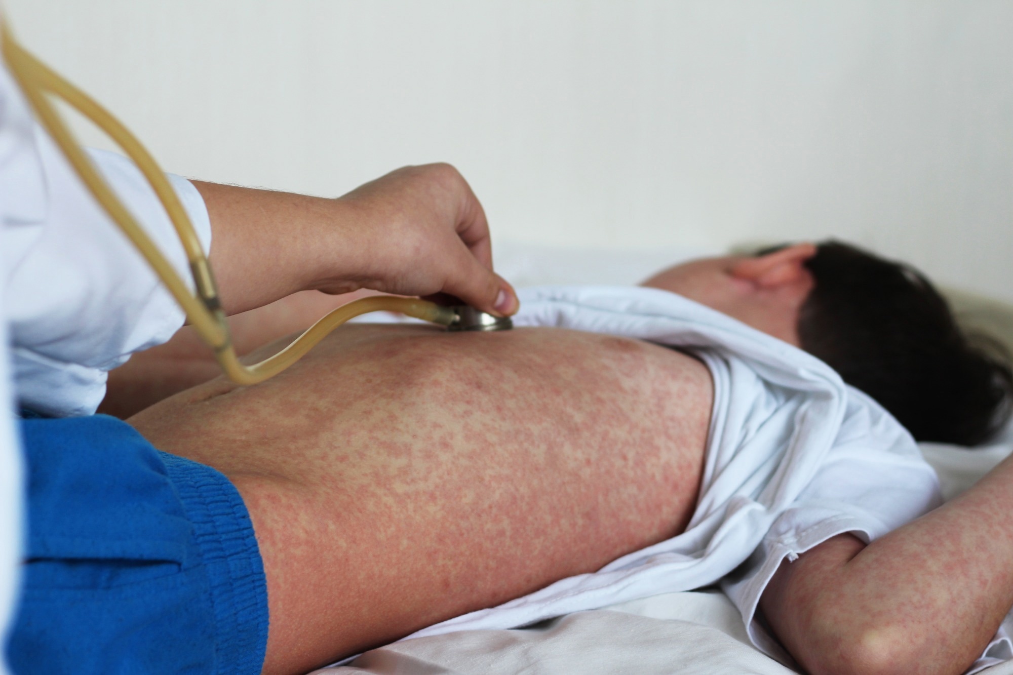 A hidden measles signal may reveal how large the next outbreak could be