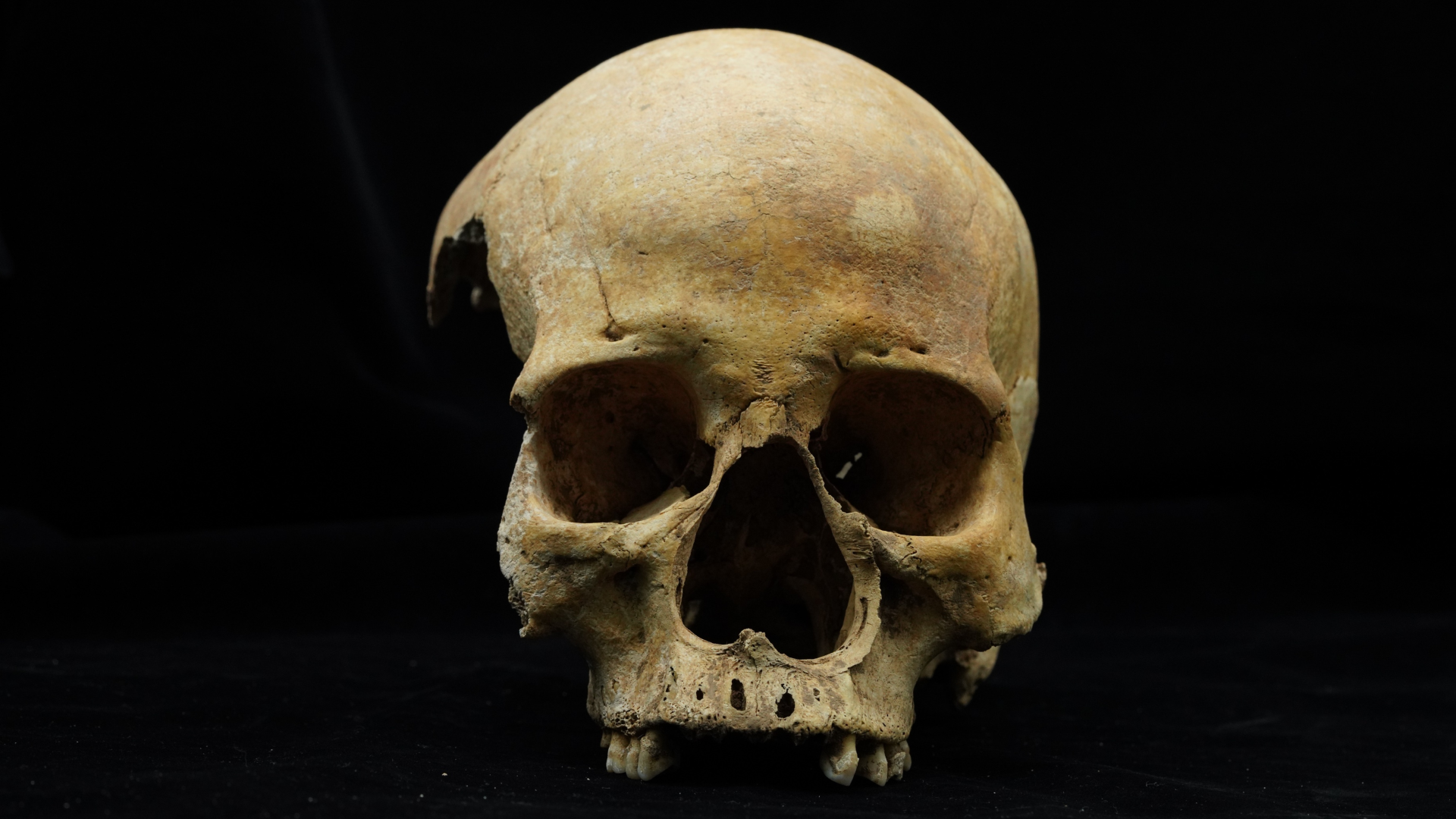 700-year-old skull from China is first ever skeletal evidence of nose amputation