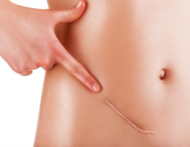 USP15 enzyme emerges as potential target for ovarian cancer treatment