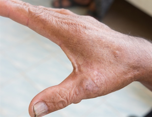 New imaging technique detects subtle skin changes in scleroderma patients