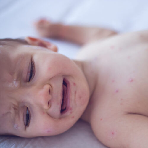 Pennsylvania issues alert on congenital measles—something US hasn’t seen for decades