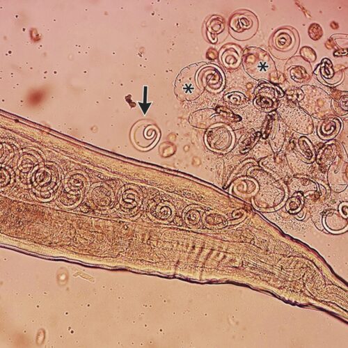 Worms mate in man’s eyes, get plucked out right before larvae burst out