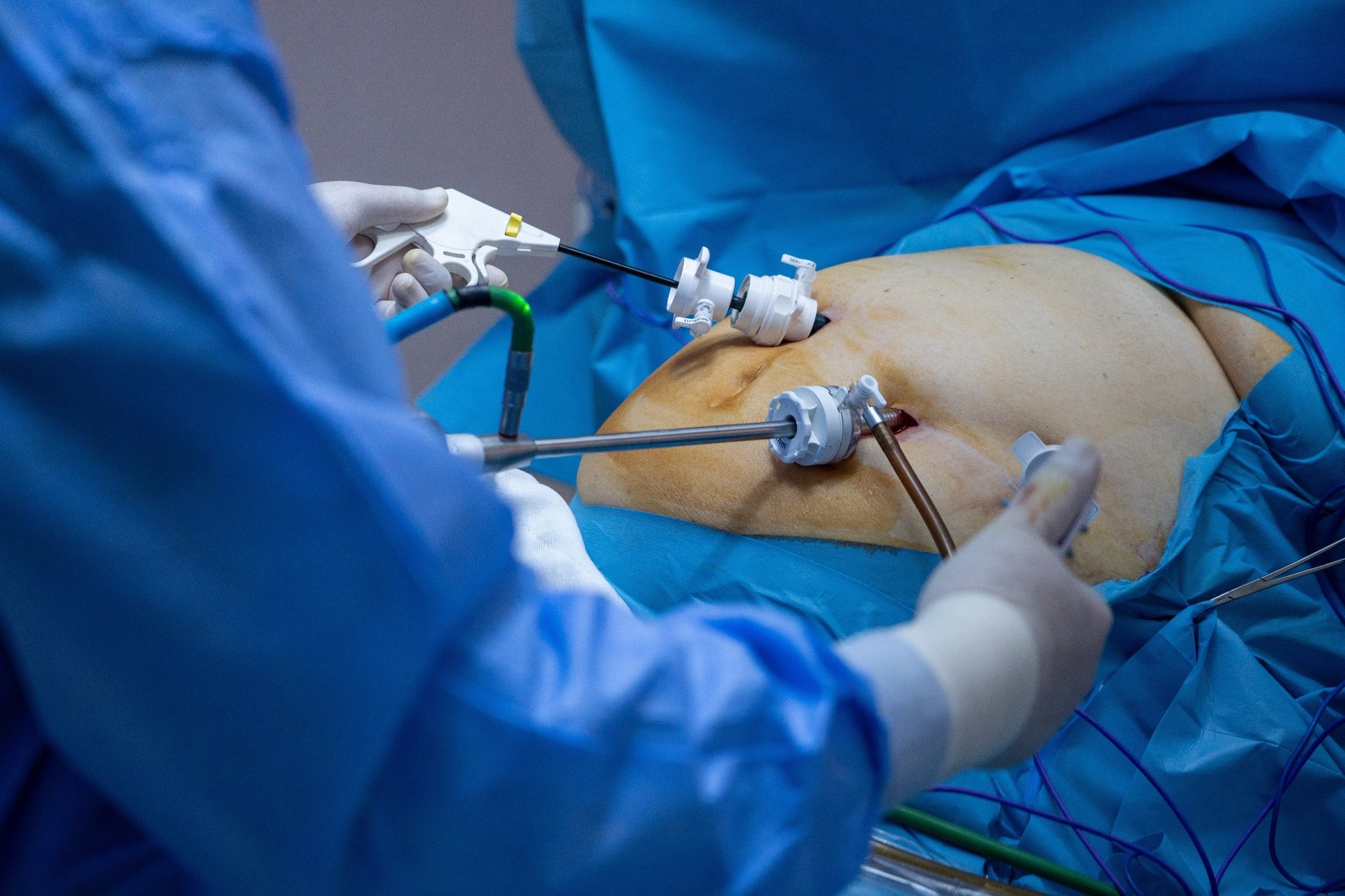 CT scans linked vitamin D levels to fat within muscles after bariatric surgery