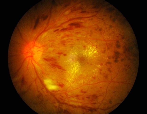 Norrin treatment prevents vision loss in diabetic rats